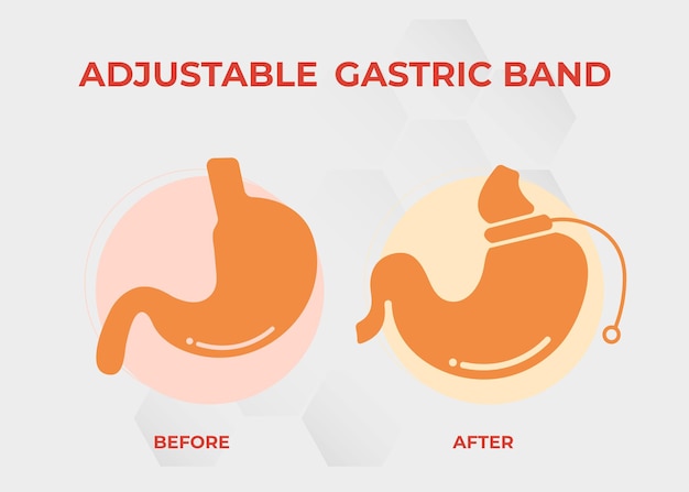 Vecteur bande gastrique réglable concevoir vecteur de chirurgie de perte de poids illustration