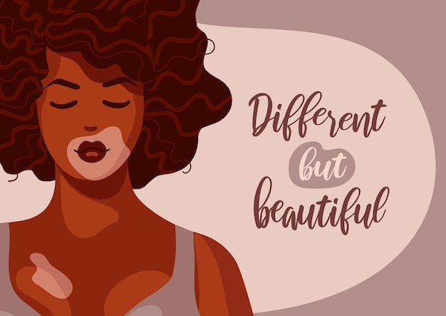 Vecteur belle femme afro-américaine vitiligo peau foncée cheveux bouclés corps dépigmentation positive