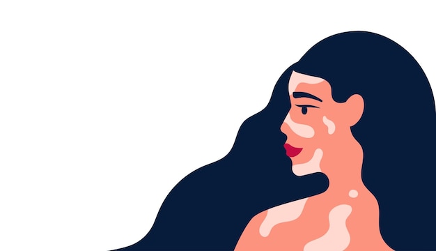 Belle femme avec une peau pigmentée de vitiligo et a beaucoup d'illustration vectorielle de cheveux bleus