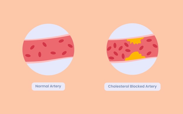 Bon Et Mauvais Cholestérol Dans Notre Illustration Vectorielle De Corps