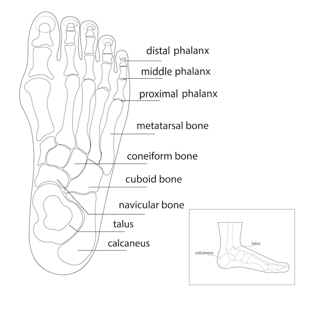 Vecteur bursite sur les côtés du pied l'os et la peau sur les côtés de l'articulation du gros orteil forment un abnor