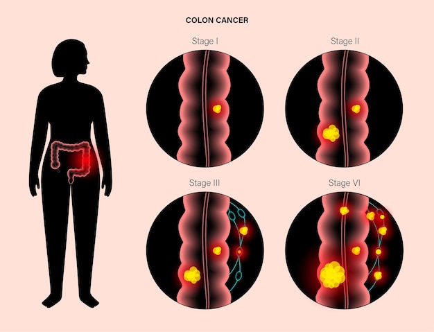 Vecteur cancer de l'intestin 3d