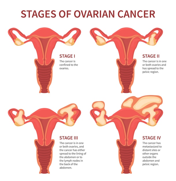 Cancer De L'ovaire Quatre Stades Mentionnant Les Ovaires