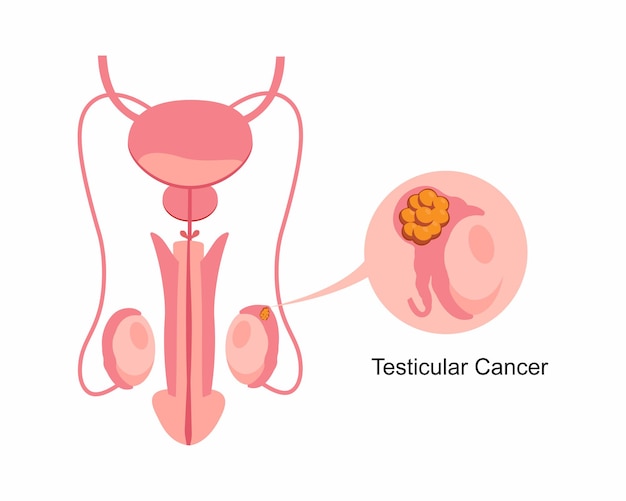 Vecteur cancer des testicules maladie du système reproducteur masculin anatomie des testicules dans le corps humain organe sexuel de l'homme