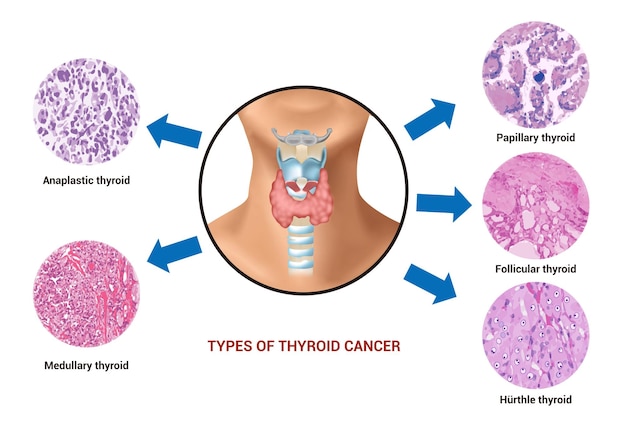 Vecteur le cancer de la thyroïde