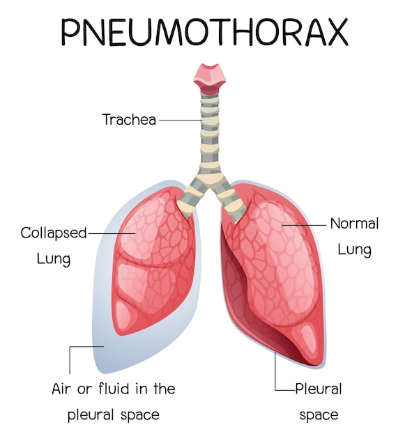 Vecteur caricature de pneumothorax de l'anatomie humaine