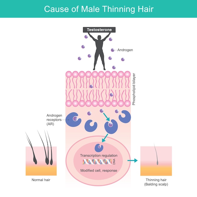 Vecteur cause des cheveux clairsemés chez les hommes. illustration pour expliquer le problème des cheveux plus fins chez les hommes à cause des sensibilités des récepteurs des cellules androgènes