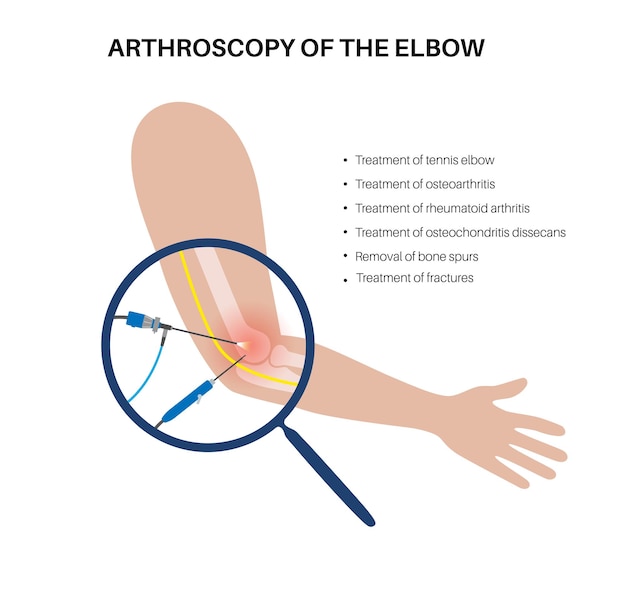 Chirurgie Mini-invasive De L'articulation Du Coude Procédure Médicale D'arthroscopie Anatomie De L'humérus Ulna Et Des Os Du Radius Douleur Du Bras Fracture Arthrose Ou Polyarthrite Rhumatoïde Illustration De Rayons X