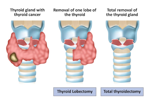 Vecteur chirurgie de la thyroïde