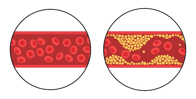 Cholestérol Et Athérosclérose