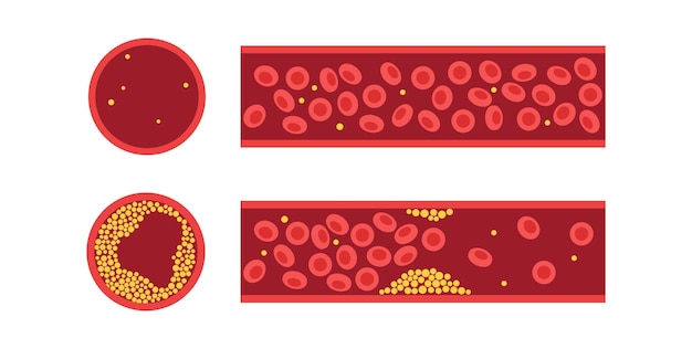Cholestérol Et Athérosclérose