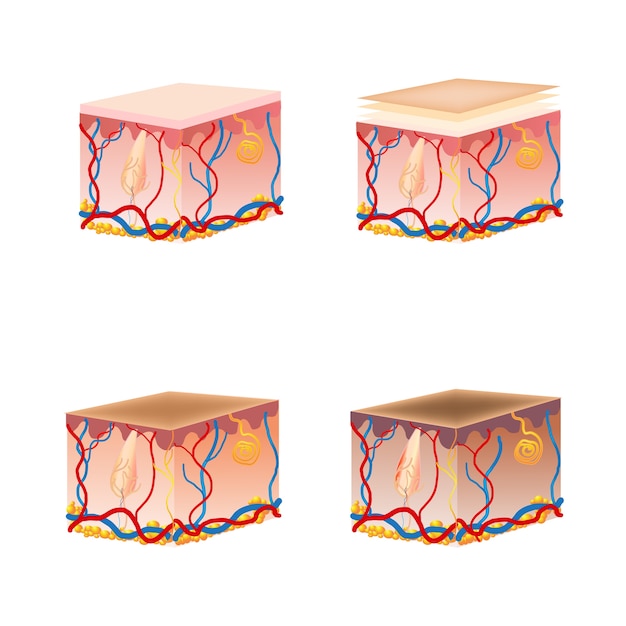 Classification de brûlure de peau. Brûlures cutanées aux premier, deuxième et troisième degrés