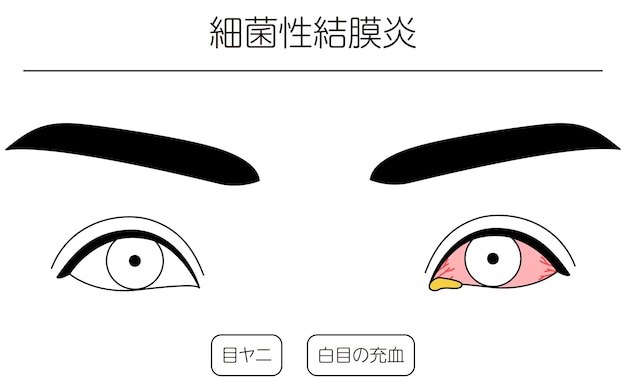 Clipart Médical Dessin Au Trait Illustration De La Maladie Des Yeux Et De La Traduction De La Conjonctivite Bactérienne