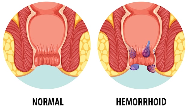 Vecteur comparaison de la normale et des hémorroïdes dans l'anatomie humaine