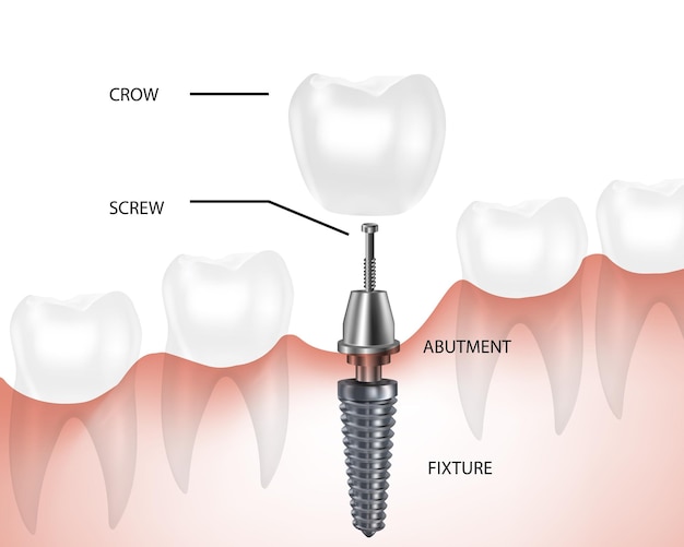 Composants De L'implant Dentaire Vecteur Des Composants De La Prothèse Dentaire