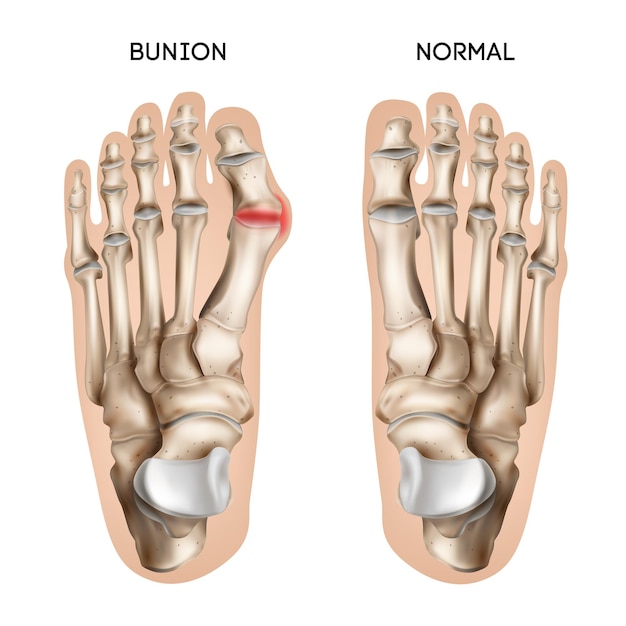 Composition De Pied D'oignon Réaliste Avec Vue Sur Les Pas Humains Normaux Et Endommagés