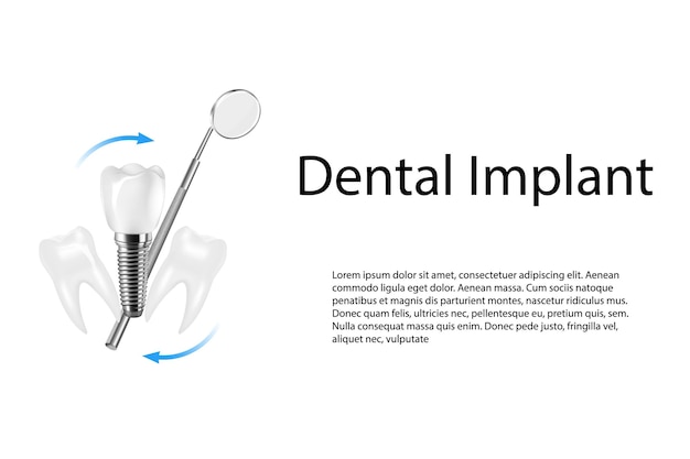 Composition réaliste en 3D de l'implant dentaire Illustration de l'activité dentaire