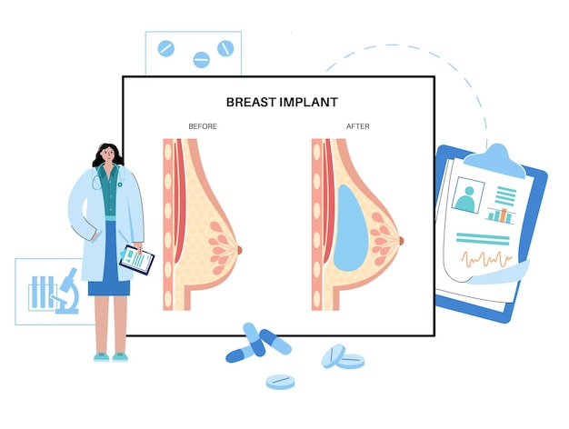 Concept D'implant Mammaire