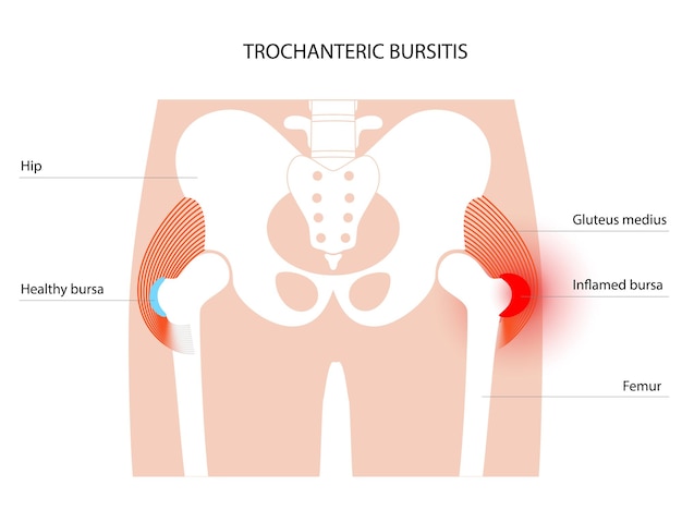 Concept D'inflammation De La Bursite