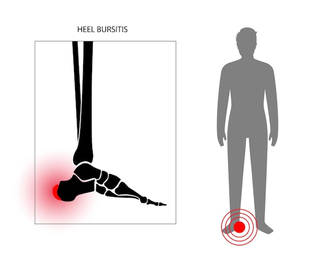 Vecteur concept d'inflammation de la bursite