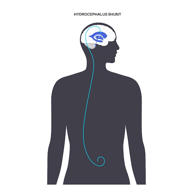 Vecteur concept de shunt d'hydrocéphalie. pression sur l'illustration vectorielle plane médicale du cerveau.