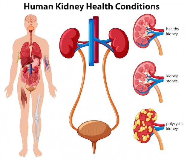 Vecteur conditions de santé du rein humain