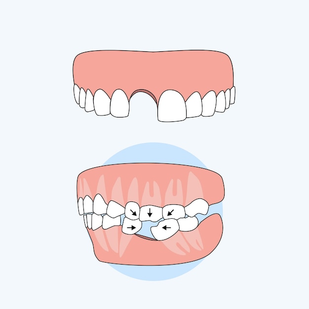 Conséquence de ne pas fixer la prothèse après une perte de dents