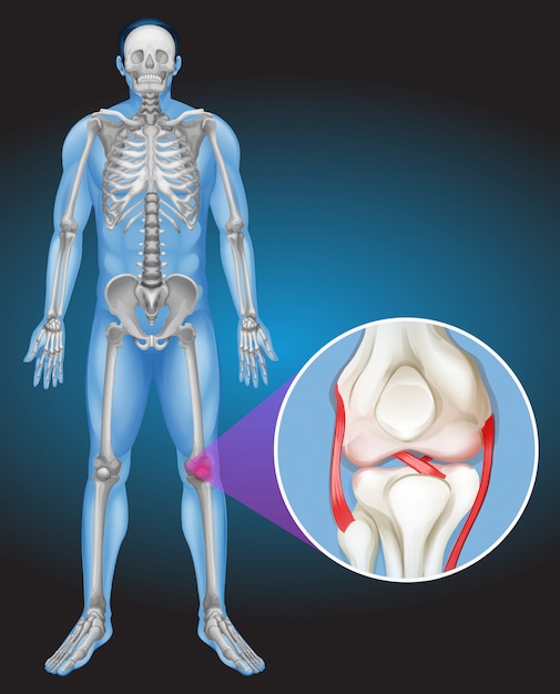 Vecteur corps humain et douleur au genou