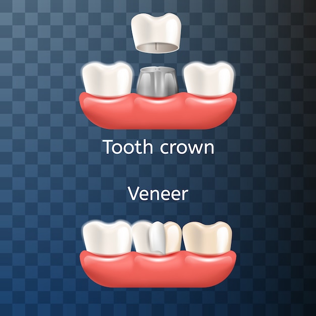 Couronne de dent dentaire réaliste Illustration, Venner