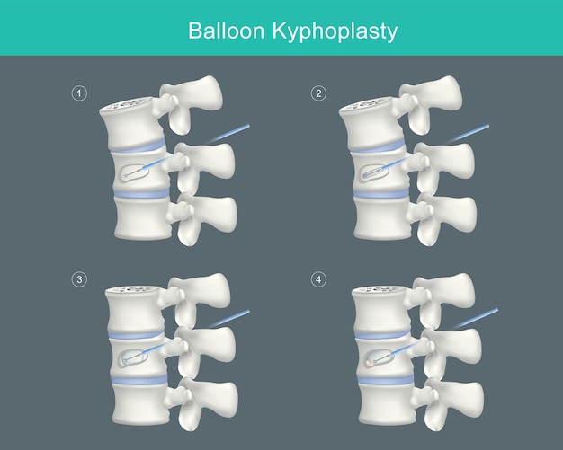 Vecteur cyphoplastie par ballonnet étapes médicales pour corriger les fractures par compression et restaurer la hauteur du corps vertébral illustrationxa