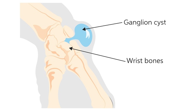 Vecteur cyste ganglionnaire formé près des articulations des mains, du genou, de la cheville ou du pied