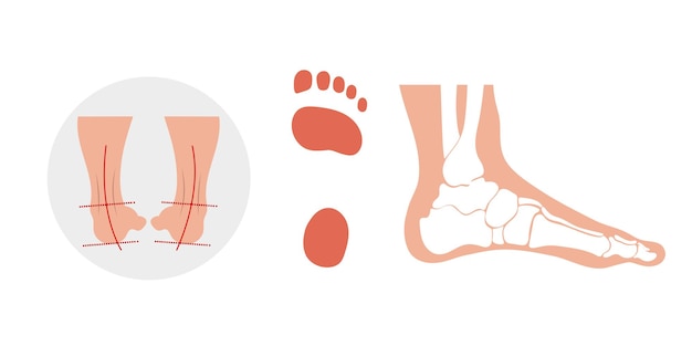 Vecteur déformation du pied chez l'homme