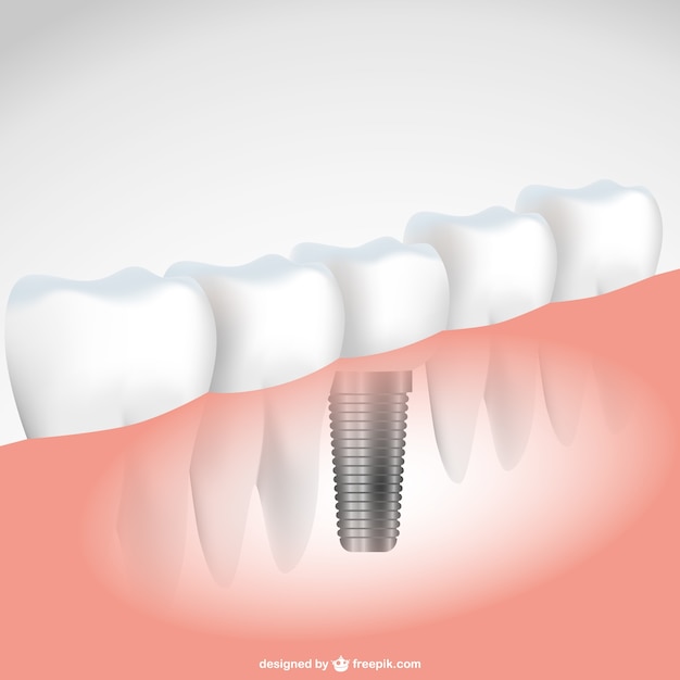 Vecteur dentaire vecteur d'implant illustration