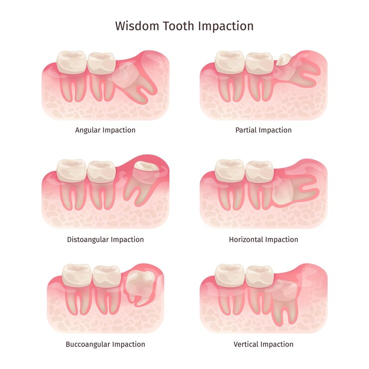 Vecteur dente de sagesse problème dentaire des dents de sagesse extraction molaire du canal racinaire traitement chirurgical de la douleur osseuse ou des gencives enlever les dents dentiste x-ray infographie illustration chic