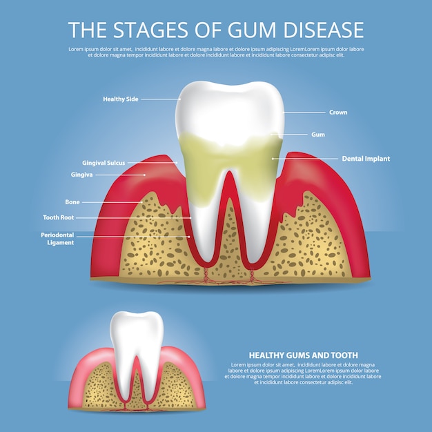 Dents humaines Étapes de la maladie des gencives Illustration