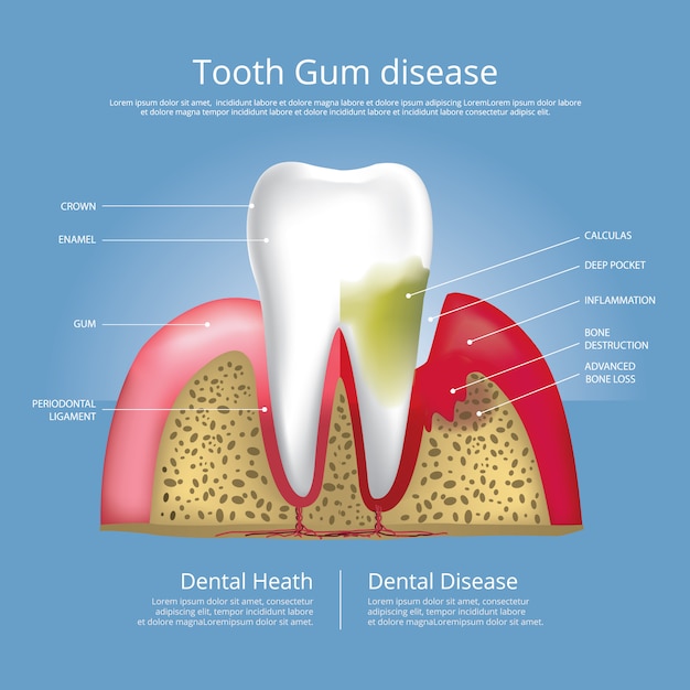 Dents humaines Étapes de la maladie des gencives Illustration