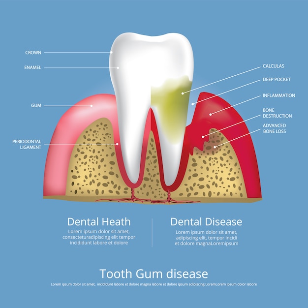 Dents humaines Étapes de la maladie des gencives Illustration