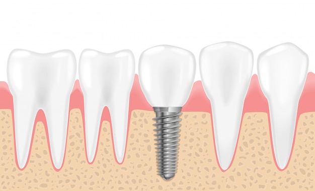 Vecteur dents et implant dentaire sains et réalistes