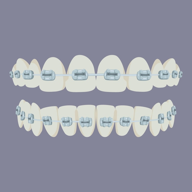 Dents propres et lisses avec des accolades Dents saines