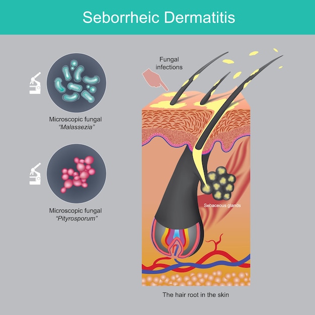 Vecteur dermatite séborrhéique problème de chute de feuilles du cuir chevelu causé par les glandes sébacées