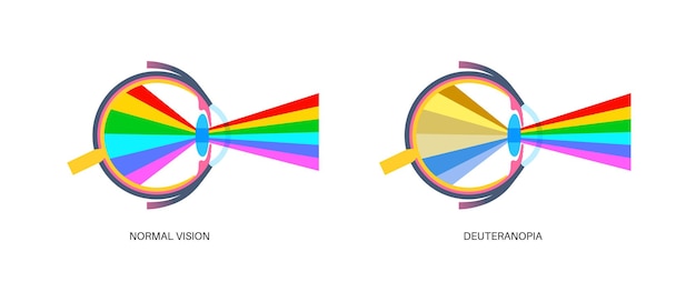 Vecteur deuteranomalie et deuteranopie