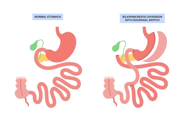 Vecteur déviation biliopancréatique avec interrupteur duodénal bpd chirurgie de l'estomac perte de poids procédure gastrique organes internes avant et après l'opération illustration vectorielle plane de problème de surpoids et d'obésité