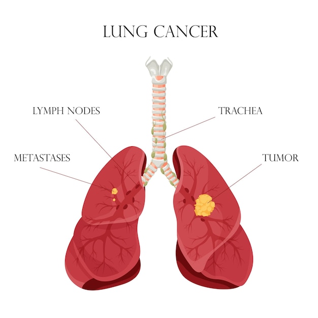 Diagramme Du Cancer Du Poumon Maladie Concept Maladie Organes Internes Humains Illustration Vectorielle Style Dessin Animé