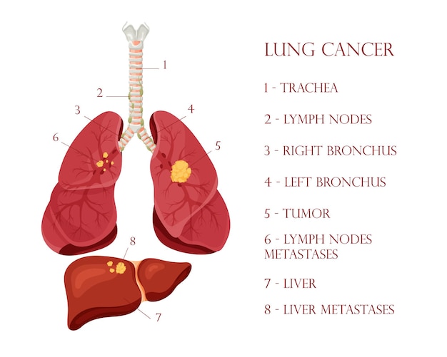 Diagramme Du Cancer Du Poumon Maladie Concept Maladie Organes Internes Humains Illustration Vectorielle Style Dessin Animé