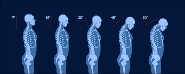 Vecteur difformité des vertèbres du cou