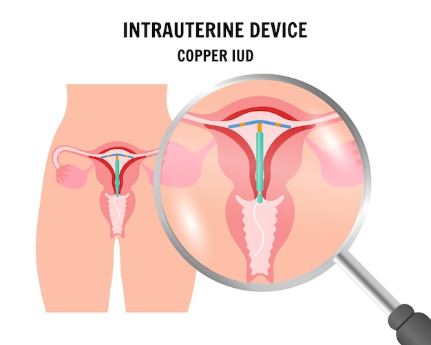 Vecteur dispositif intra-utérin dans le système reproducteur féminin en vecteur