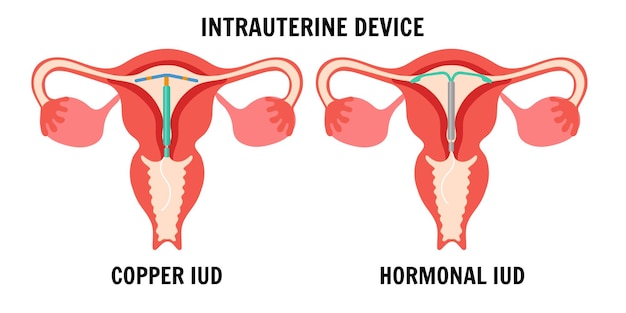 Vecteur dispositifs intra-utérins iud en vecteur