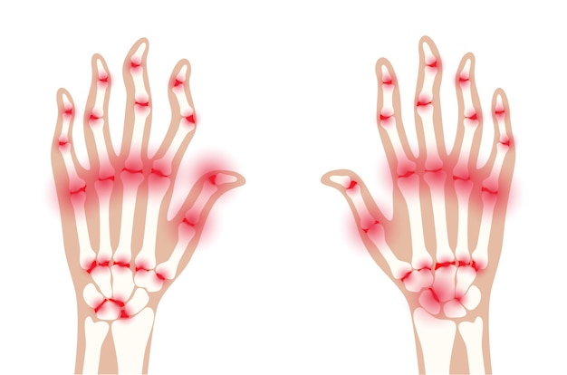 Douleur et inflammation en main sur la radiographie. Symptôme de polyarthrite rhumatoïde sur les articulations humaines
