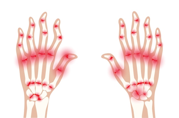 Vecteur douleur et inflammation en main sur la radiographie. symptôme de polyarthrite rhumatoïde sur les articulations humaines