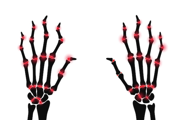 Douleur Et Inflammation En Main Sur La Radiographie. Symptôme De Polyarthrite Rhumatoïde Sur Les Articulations Humaines